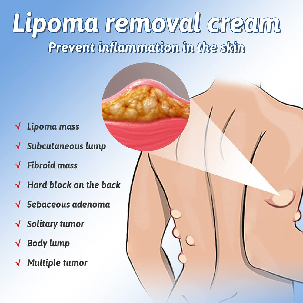 Herbal Lipoma Removal Cream (50gm)