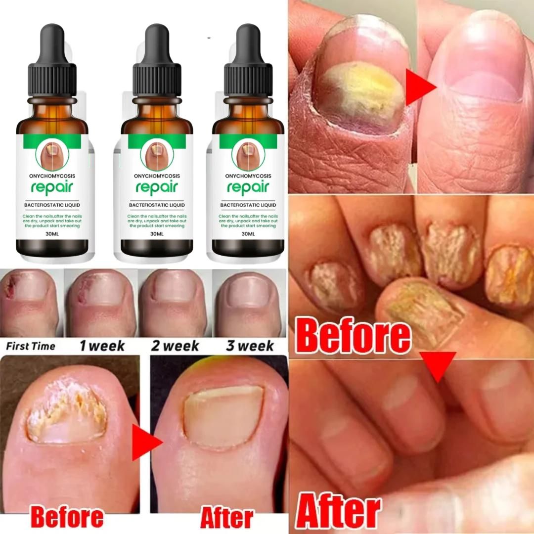 All in One Nail Growth & Repair Serum 🔥 80% Off Sale🔥