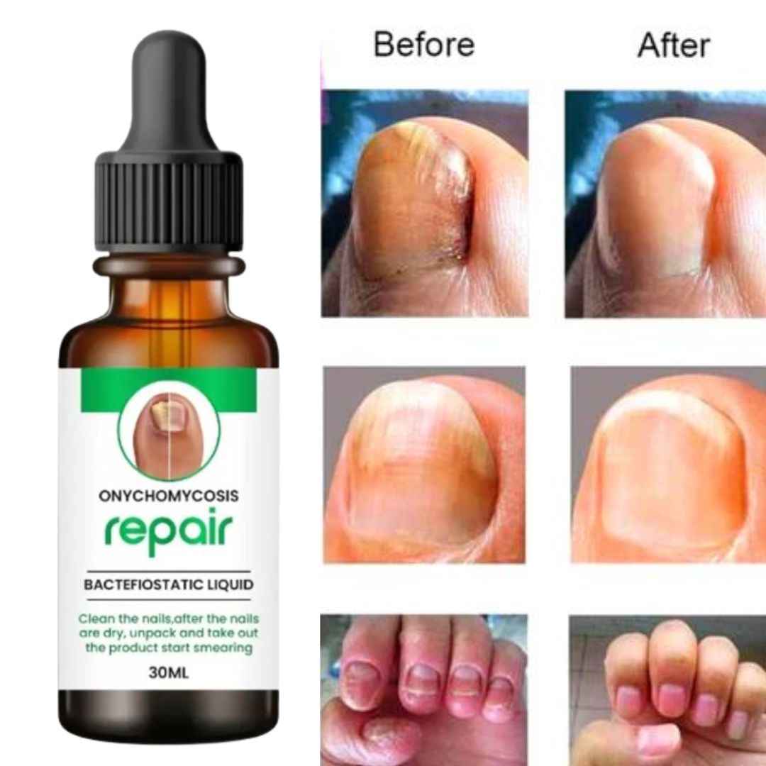 Nail Growth & Repair Serum 👨🏻‍⚕️Doctor's Recommended🔥
